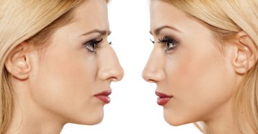 rinoplastia turquia